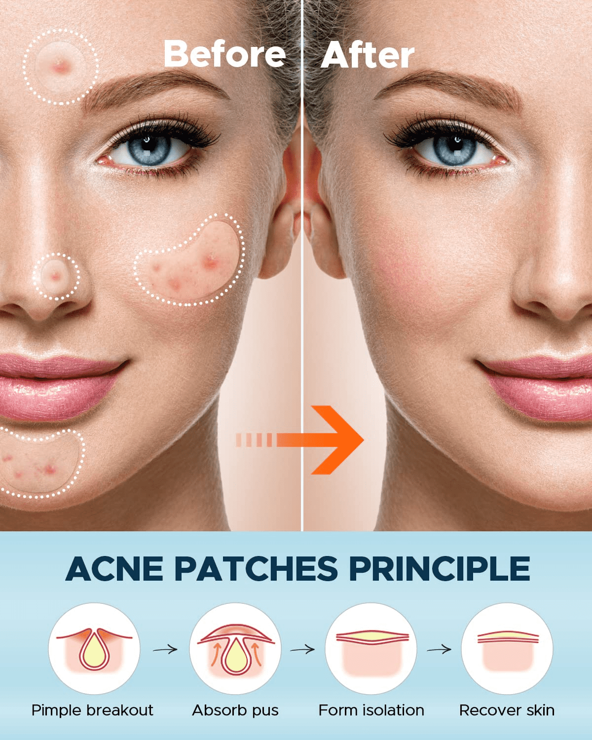 Pimple Patches Set, Hydrocolloid Patches for Covering Zits and Blemishes, Pimples nose stick oval chin stick, Spot Stickers for Face and Skin