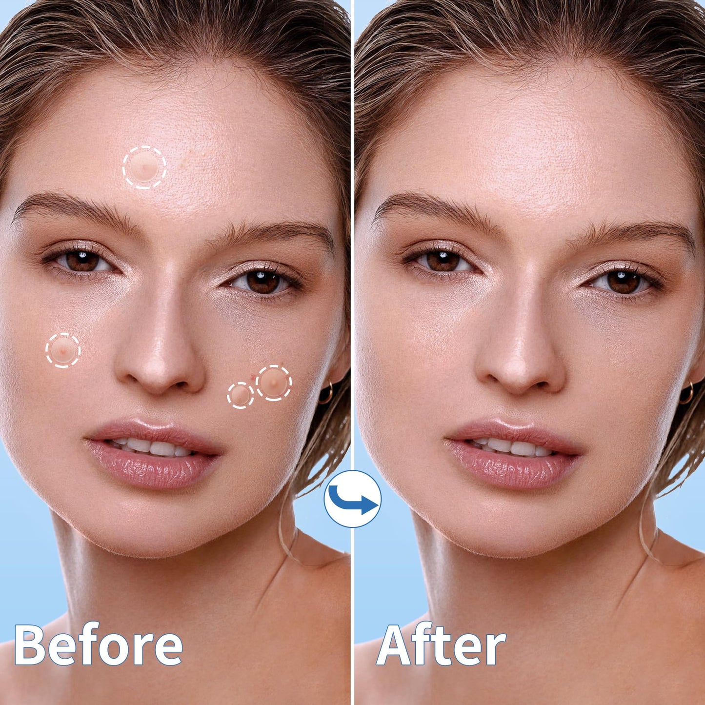 Pimple Patches for Face, 4 Size 300 Counts Acne Patches, Hydrocolloid Patches for Covering Zits and Blemishes, Spot Stickers for Face and Skin