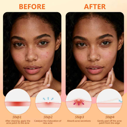 Pimple Patches for Face, 225 Counts Hydrocolloid Acne Patches, Star Heart Shape Zit Covers, Colorful Superstar Spot Acne Pimple Patches Stickers